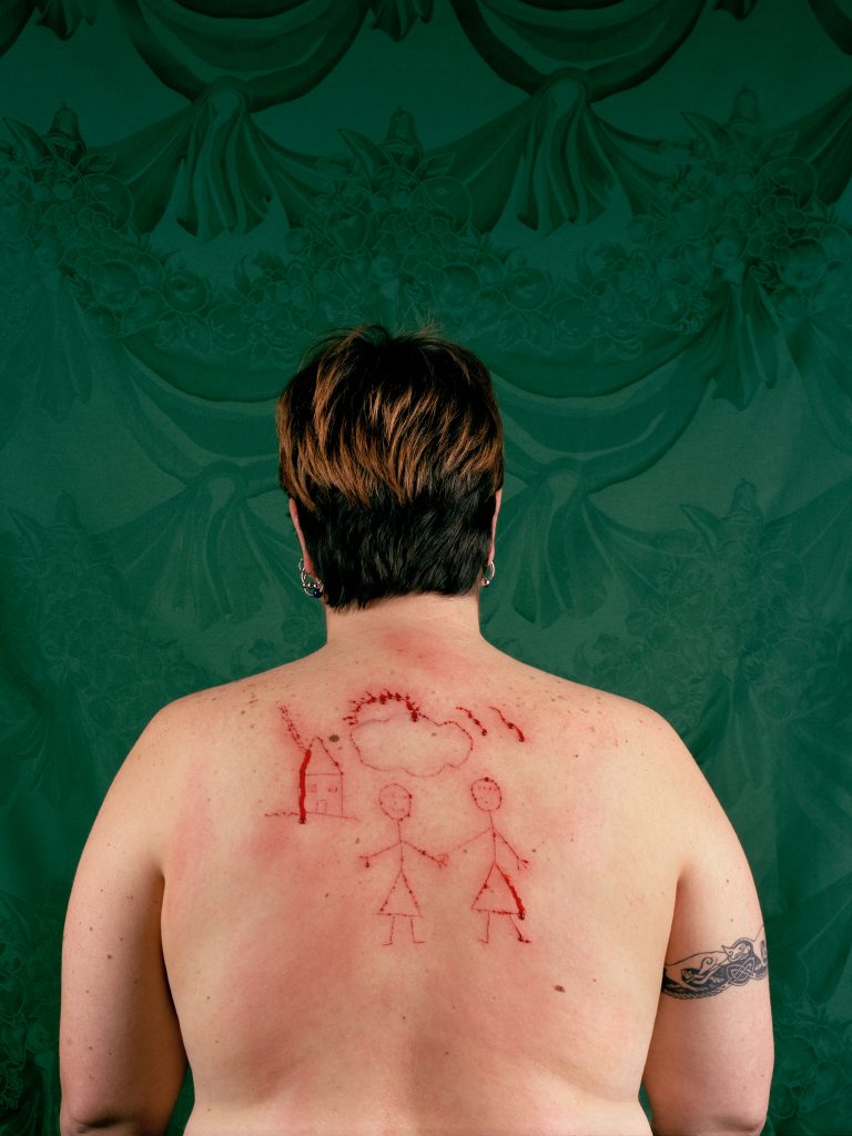 Photograph of person with scratches on back in front of green background. 